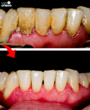 JatoClean®  - Irrigador Oral para Limpeza Bucal
