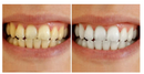 Super Fita Clareadora Dental A Base de Bambu e Carvão Vegetal - WhiteTeeth®(DENTES BRANCOS EM 30 MINUTOS)