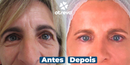 OpenEyes - Creme Reparador Rápido de Olhos (Elimina Rugas, Bolsas e Olheiras)