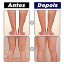 Creme Removedor Rápido de Varizes - Varimax® (ELIMINAÇÃO TOTAL DAS VARIZES)