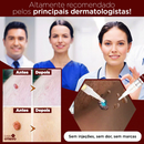 PenWart® - Caneta Removedora de Verrugas e Sinais da Pele (EFEITO IMEDIATO)