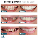 Nature Smile® - Facetas Dentárias Removíveis (COMPRE 1 PAR E LEVE OUTRO)