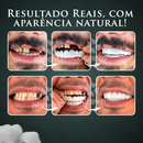 Nature Smile® - Facetas Dentárias Removíveis (COMPRE UM PAR E LEVE OUTRO PAR DE GRAÇA)
