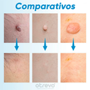 Removedor de Verrugas e Sinais da Pele