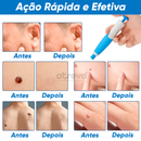 Removedor de Verrugas e Sinais da Pele