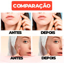 Adesivo Secador e Clareador de Espinha 36/144 Peças - SKIN PATCH®